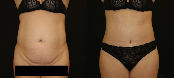 Abdominoplasty before and after photo by Kierney & Chung Plastic Surgery in Puyallup, WA