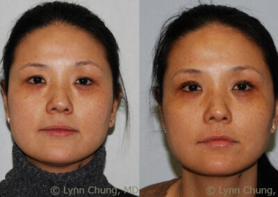Blepharoplasty before and after photo by Kierney & Chung Plastic Surgery in Puyallup, WA