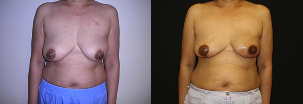 Breast Reconstruction before and after photo by Kierney & Chung Plastic Surgery in Puyallup, WA