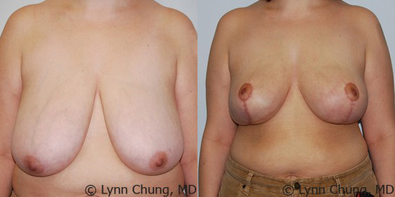 Breast Reduction before and after photo by Kierney & Chung Plastic Surgery in Puyallup, WA