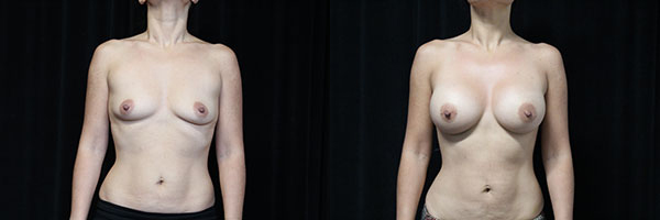 Ideal Implants before and after photo by Kierney & Chung Plastic Surgery in Puyallup, WA