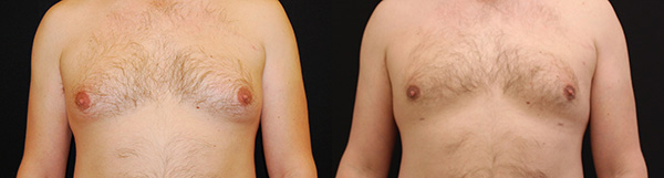 Male Breast Reduction before and after photo by Kierney & Chung Plastic Surgery in Puyallup, WA