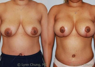 Breast Augmentation before and after photo by Kierney & Chung Plastic Surgery in Puyallup, WA