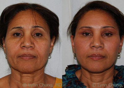 Blepharoplasty before and after photo by Kierney & Chung Plastic Surgery in Puyallup, WA
