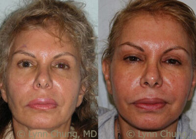 Neck Lift before and after photo by Kierney & Chung Plastic Surgery in Puyallup, WA