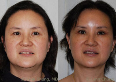 Submental Liposuction before and after photo by Kierney & Chung Plastic Surgery in Puyallup, WA
