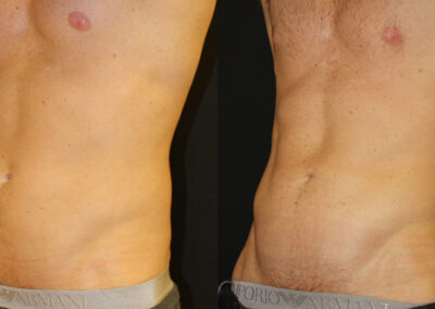 Liposuction before and after photo by Kierney & Chung Plastic Surgery in Puyallup, WA