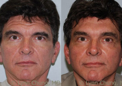 Blepharoplasty before and after photo by Kierney & Chung Plastic Surgery in Puyallup, WA