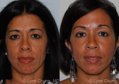 Blepharoplasty before and after photo by Kierney & Chung Plastic Surgery in Puyallup, WA