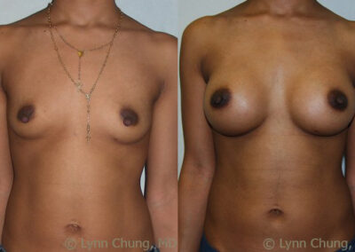 Breast Augmentation before and after photo by Kierney & Chung Plastic Surgery in Puyallup, WA