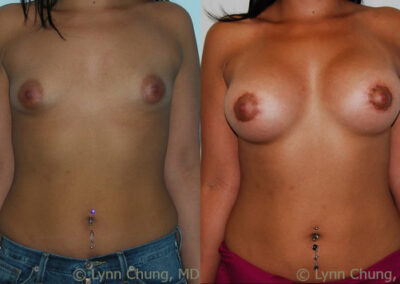 Breast Augmentation before and after photo by Kierney & Chung Plastic Surgery in Puyallup, WA