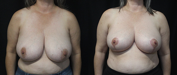 Breast Reduction before and after photo by Kierney & Chung Plastic Surgery in Puyallup WA featured
